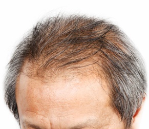 hair loss